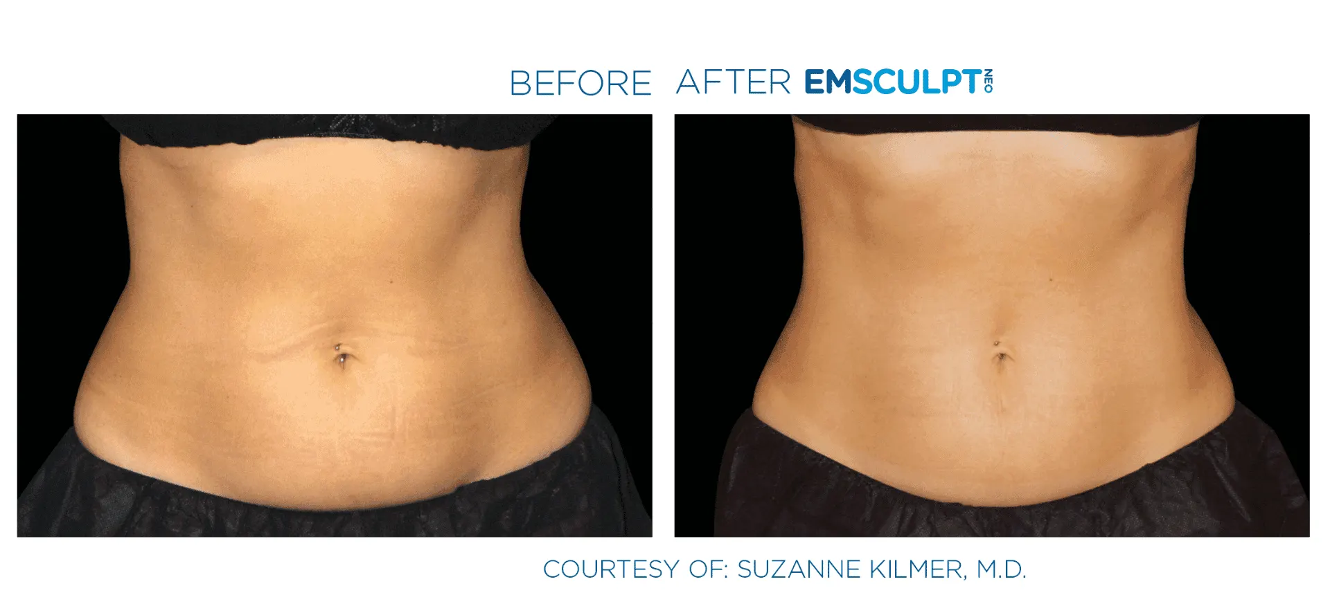 Emsculpt Neo before and after