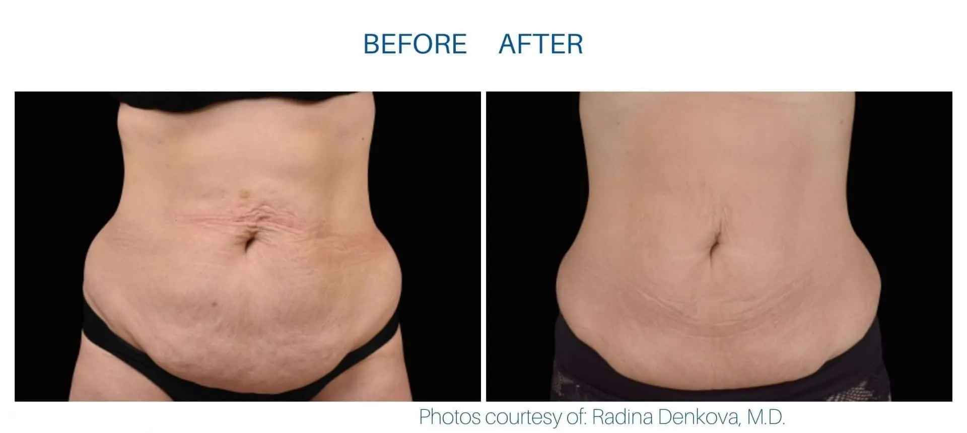 Emsculpt Neo in Tampa, FL before and after