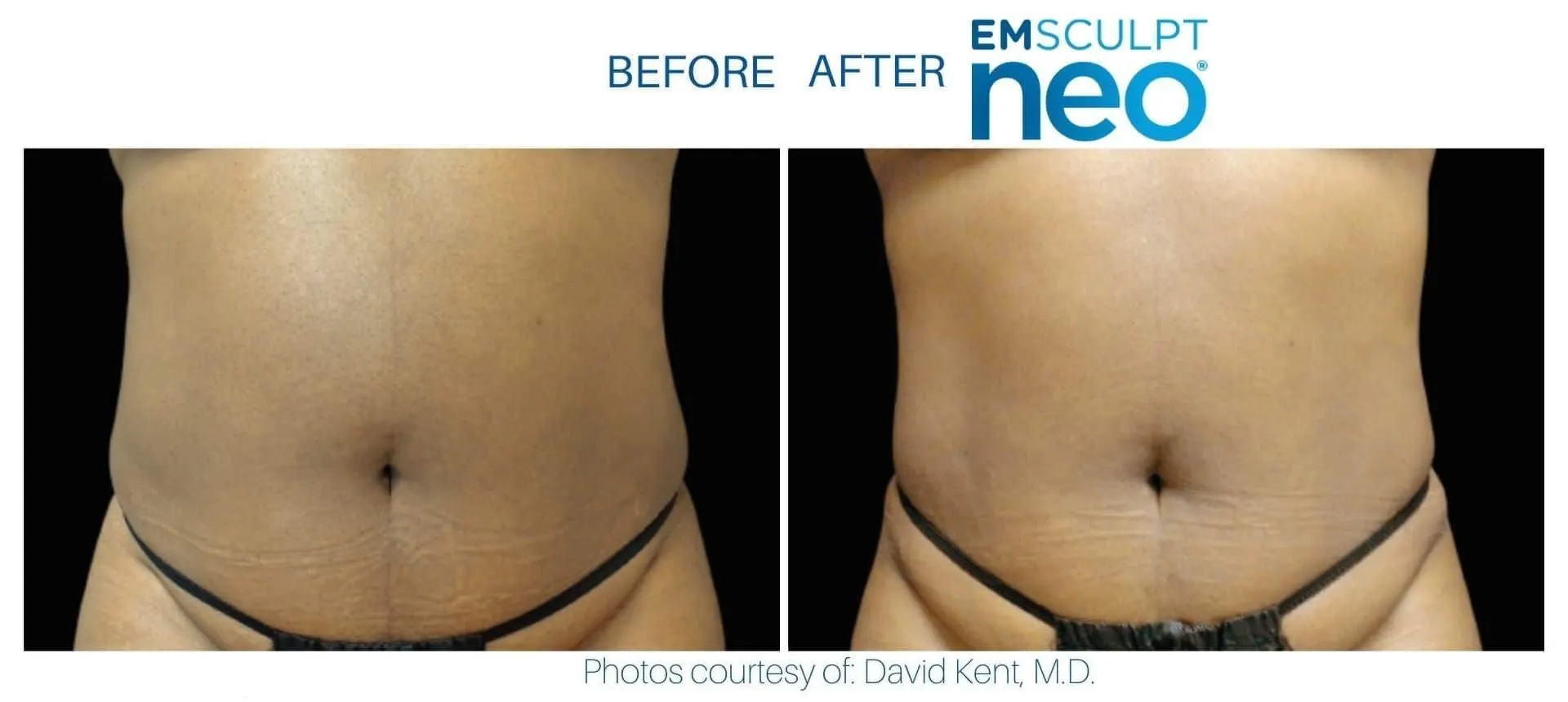 Emsculpt Neo in Tampa, FL before and after