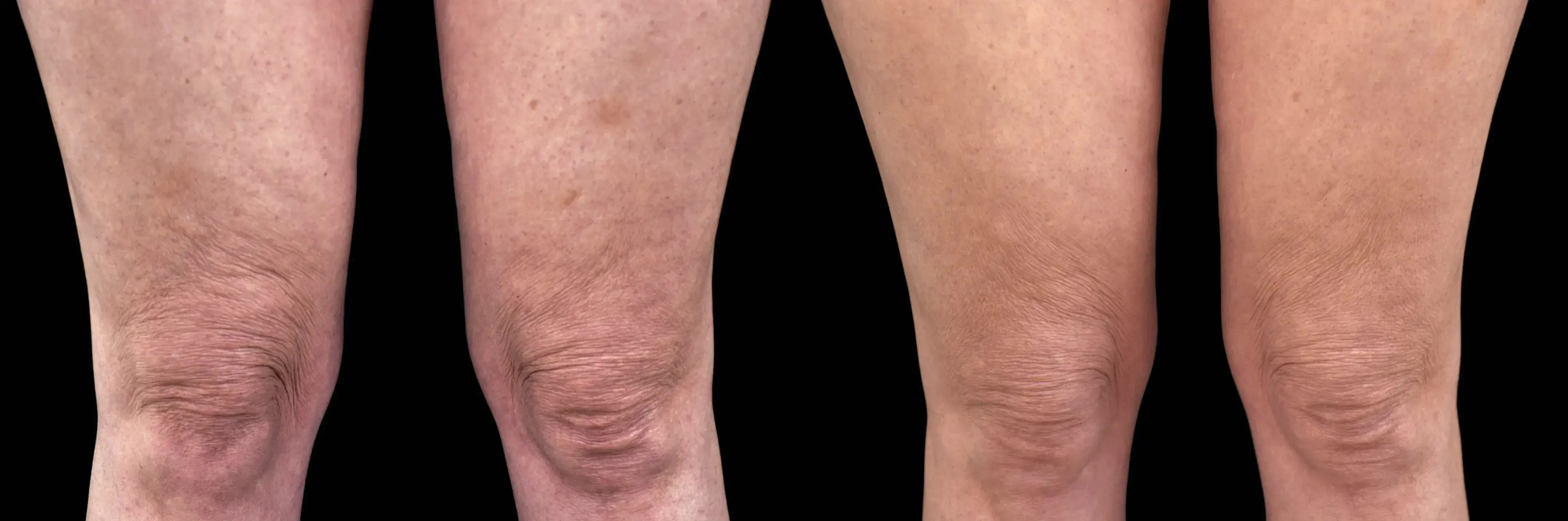 Emtone in Tampa, FL before and after