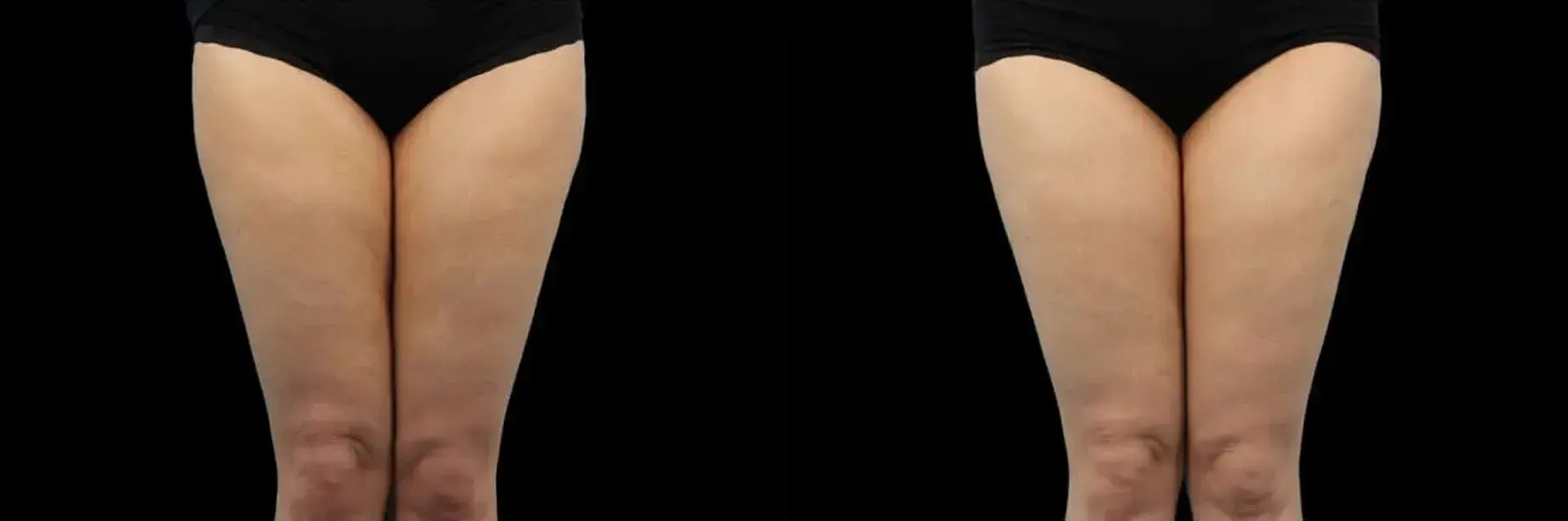 Emtone before and after